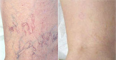 VARICOSE AND SPIDER VEINS SCLEROTHERAPY TREATMENT at La Boussole