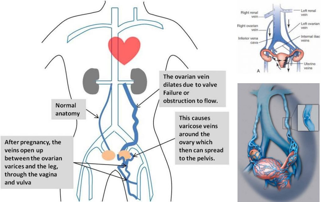 Varicose pelvis este