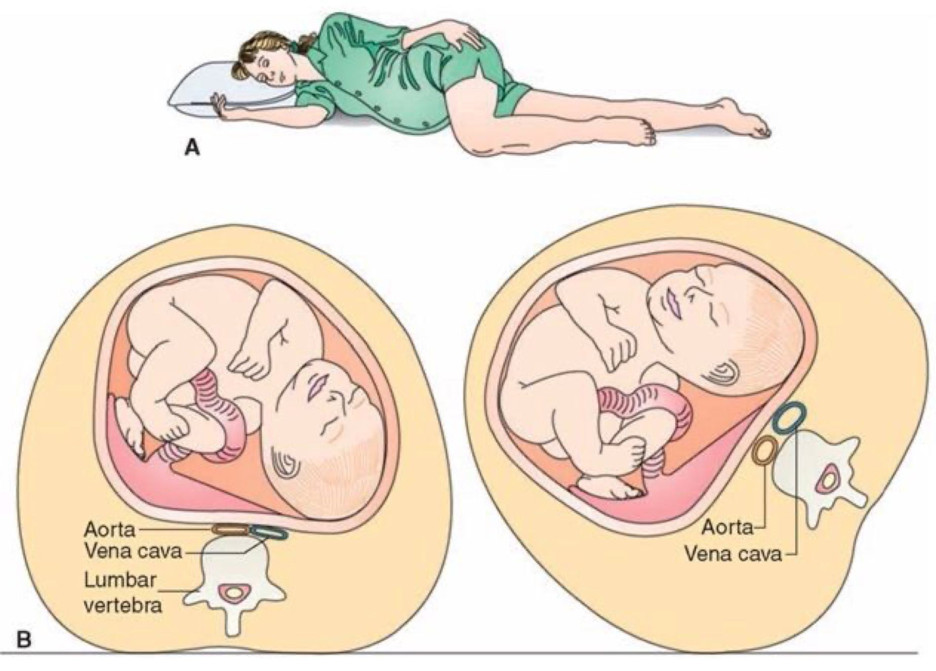 Preparate din varicose mici pelvis, Vene varicoase detralex în pelvis